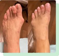 Flat Foot Therapy South Amboy