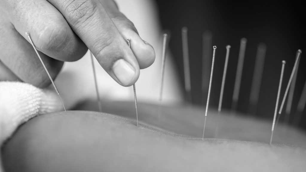 Best Acupuncture in Brighton for Optimal Health