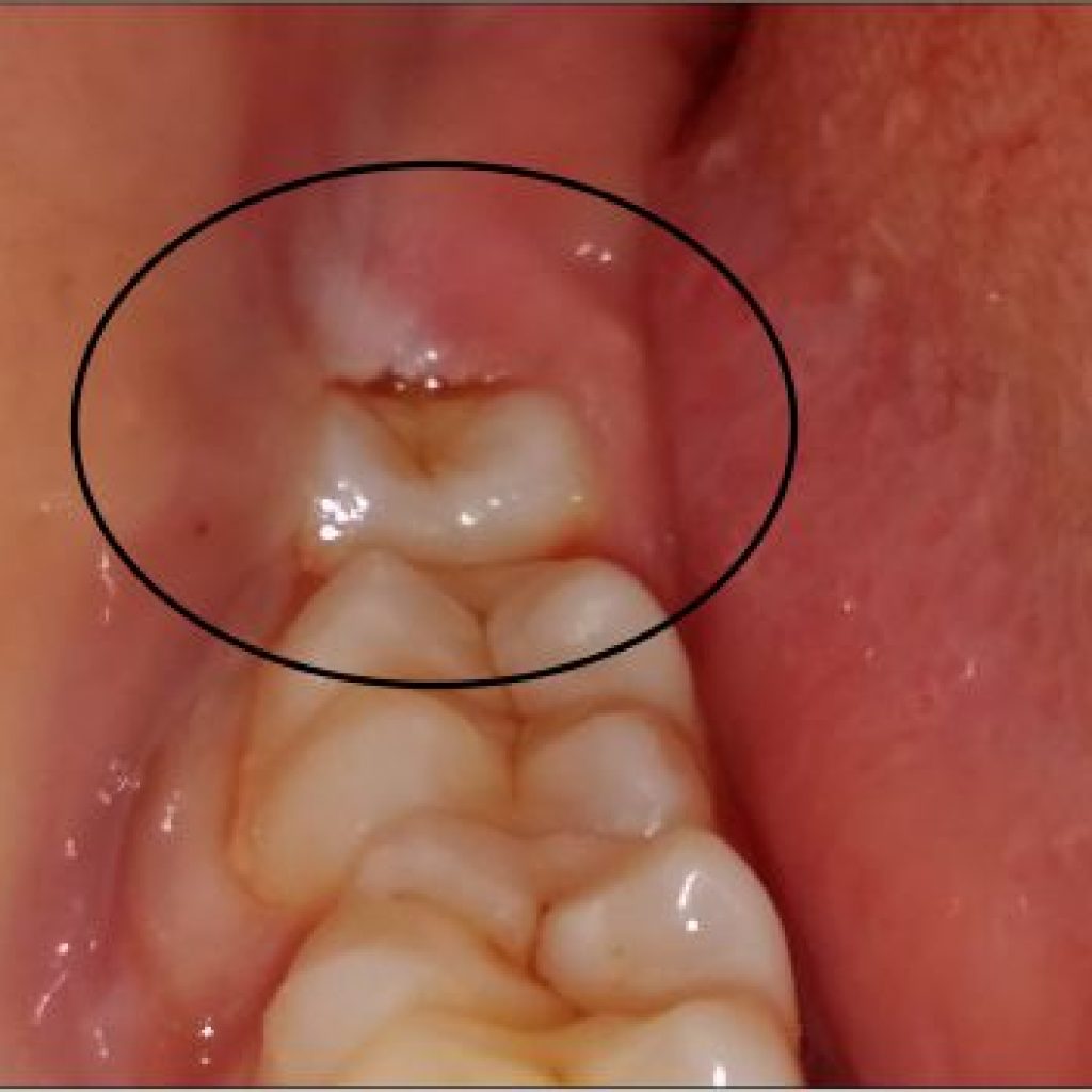 Braces & Aligners Rajkot: Smile Confidently