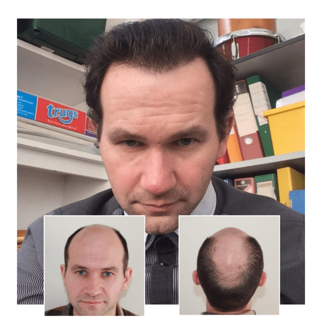 Hair Transplant Kent: Restore Confidence with Expert Care Hair Transplant Kent: Restore Confidence with Expert Care