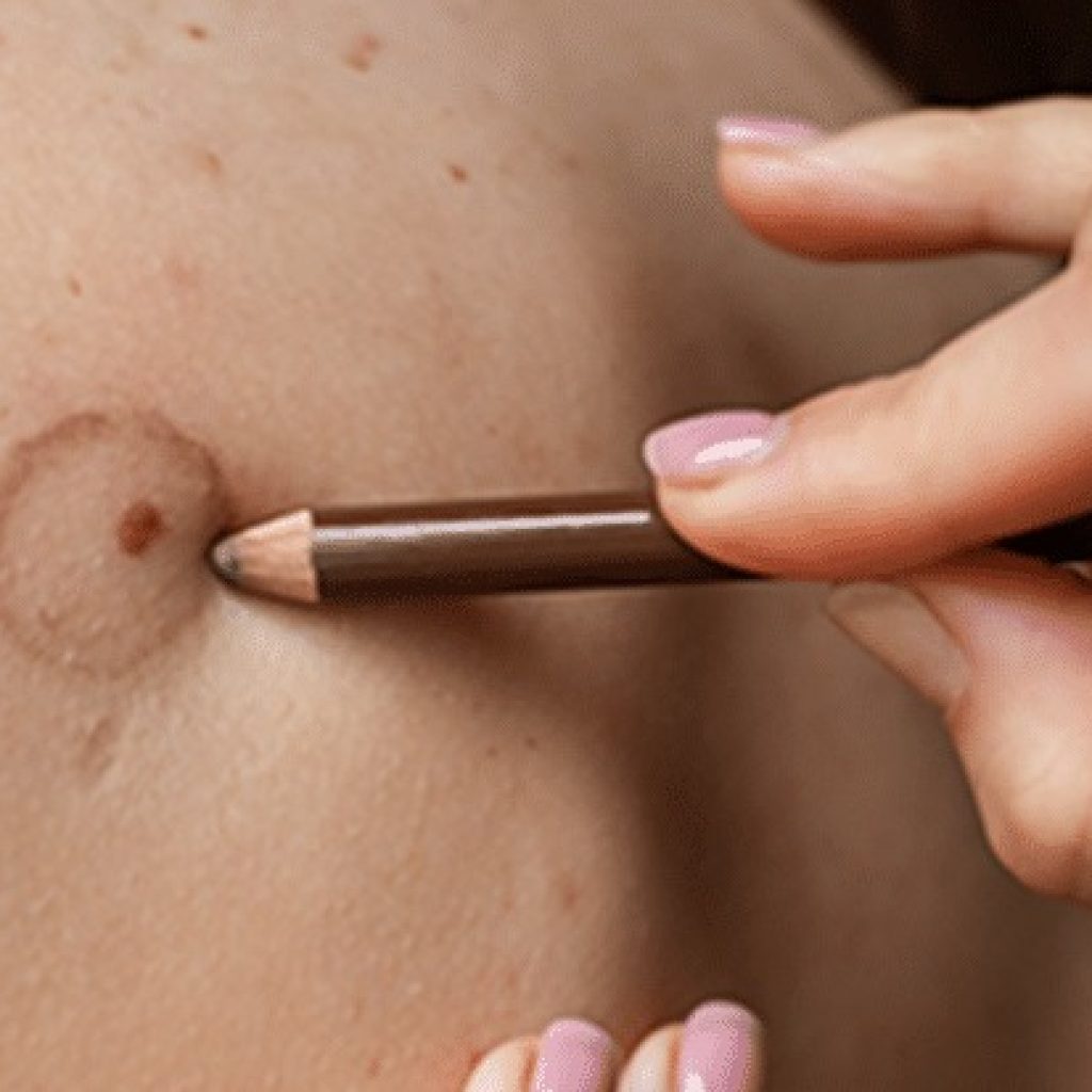 Conceal Scars Naturally with Expert Camouflage Treatments