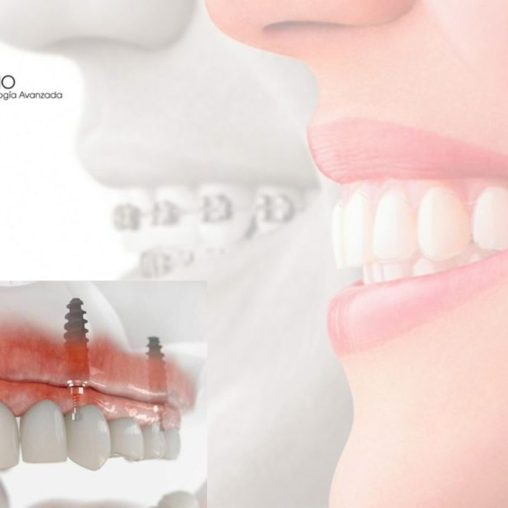 Sonrisa perfecta con ortodoncia discreta en Pozuelo de AlarcĂłn Sonrisa perfecta con ortodoncia discreta en Pozuelo de AlarcĂłn