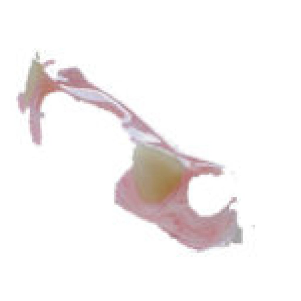 New Comfort for Your Dentures: Expert Relines in Brisbane New Comfort for Your Dentures: Expert Relines in Brisbane