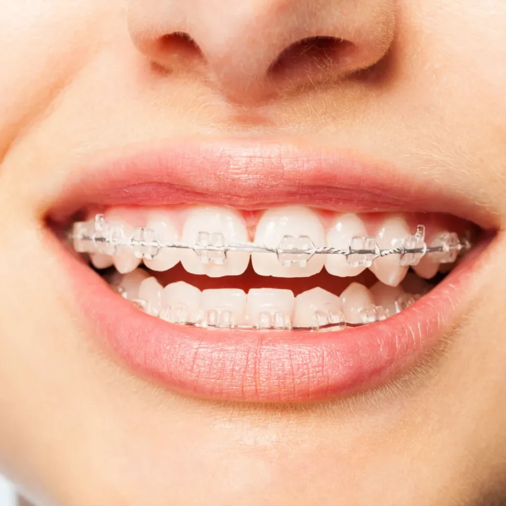 Plan Your Smile: Understanding Costs and What Affects Orthodontic Treatments Plan Your Smile: Understanding Costs and What Affects Orthodontic Treatments