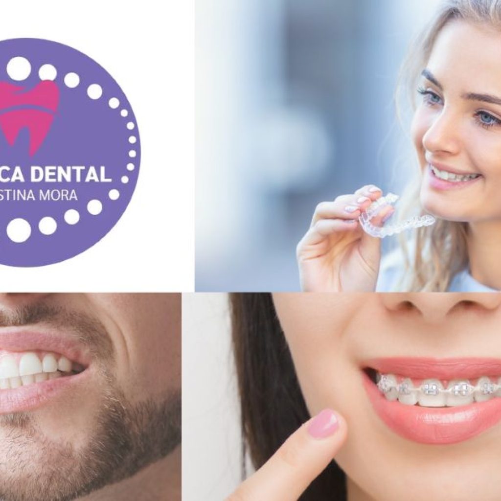Senyals d’un somriure perfecte: ortodòncia sense brackets a Gines Senyals d’un somriure perfecte: ortodòncia sense brackets a Gines