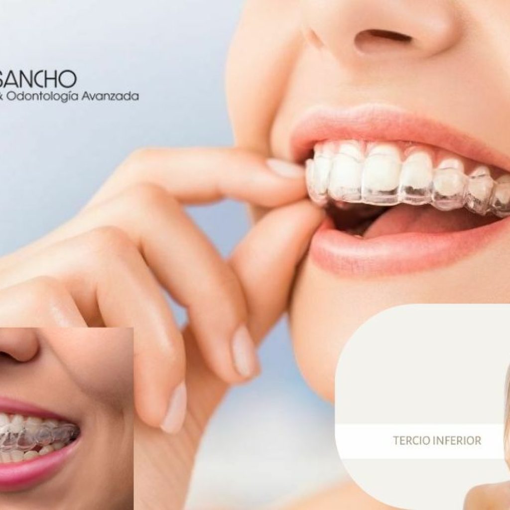 Sonrisa perfecta con ortodoncia discreta en Pozuelo de AlarcĂłn Sonrisa perfecta con ortodoncia discreta en Pozuelo de AlarcĂłn
