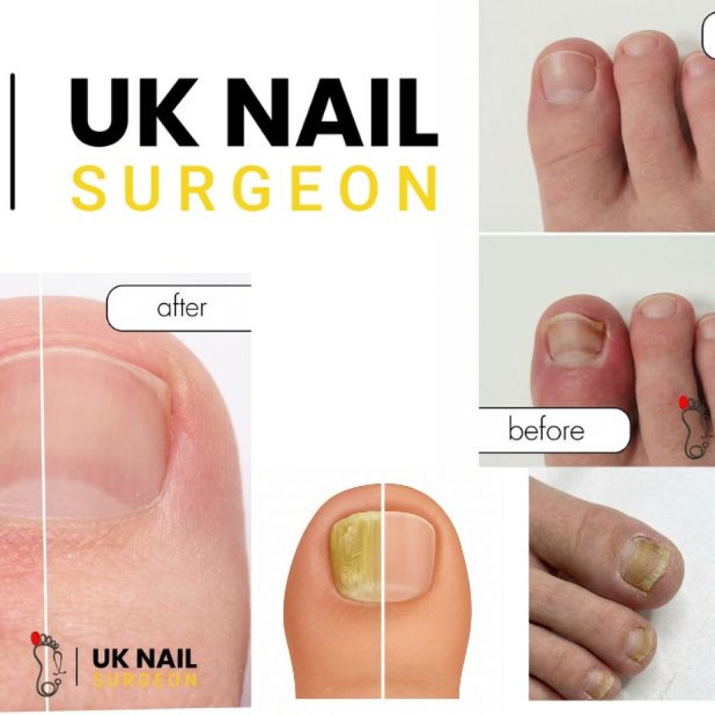How to Relieve Pain and Remove an Ingrown Nail Safely