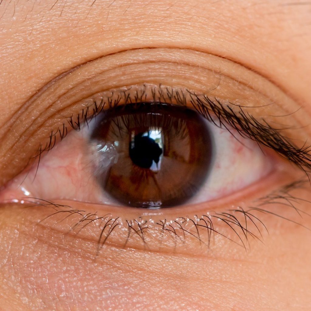 Understanding Pterygium: Causes, Symptoms and Treatment Options