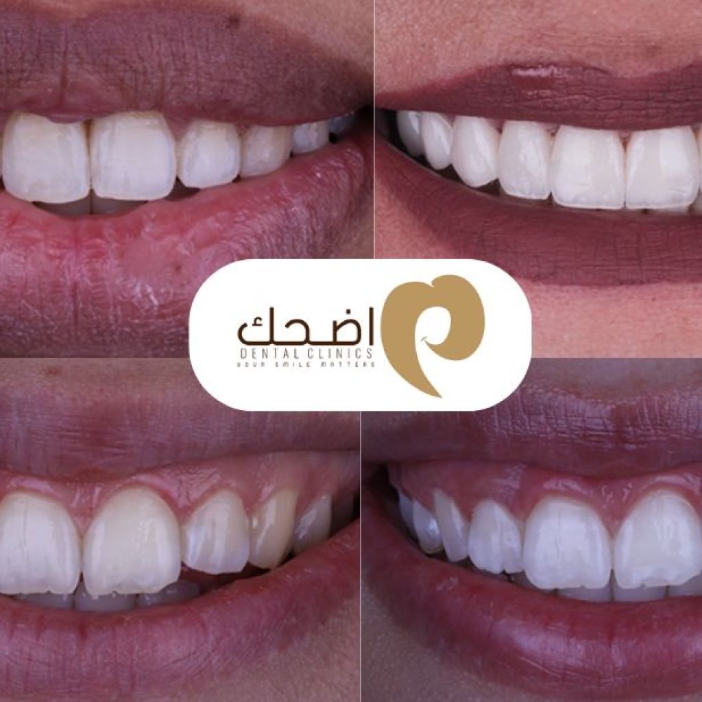 دليل زراعة الأسنان في بنها: خيارات وتقنيات حديثة