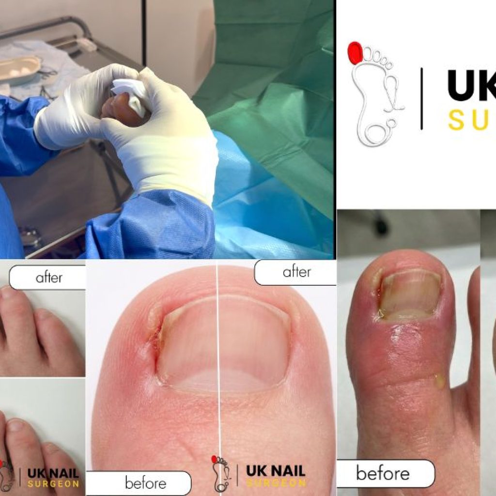 Expert Toenail Fungal Care: Safe Removal & Recovery Guidance
