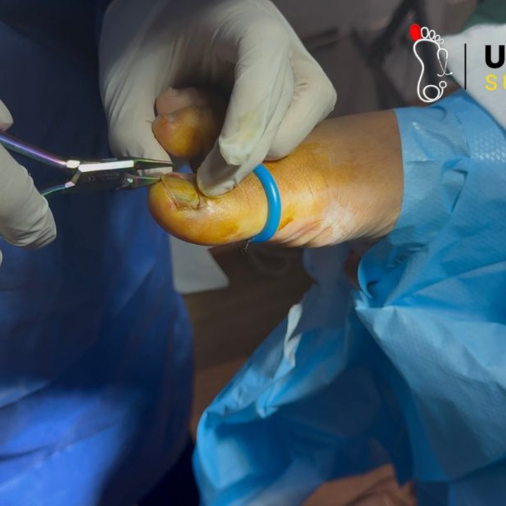 Relief and Care for Ingrown Toenails: Safe, Expert Treatments Relief and Care for Ingrown Toenails: Safe, Expert Treatments