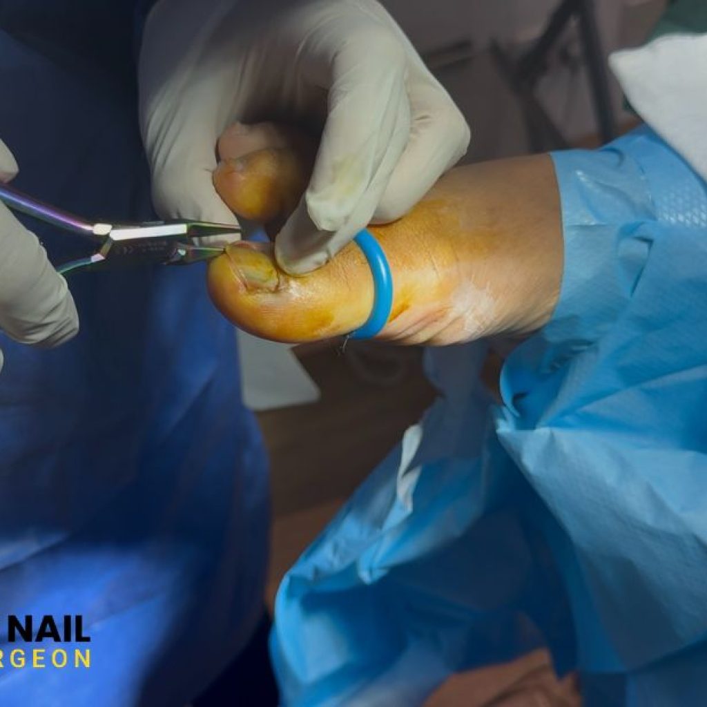 Relief and healing for painful toenails – expert care