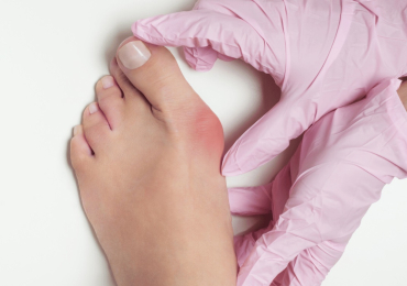 Bunion Treatment without Surgery in Sydney for Pain Relief